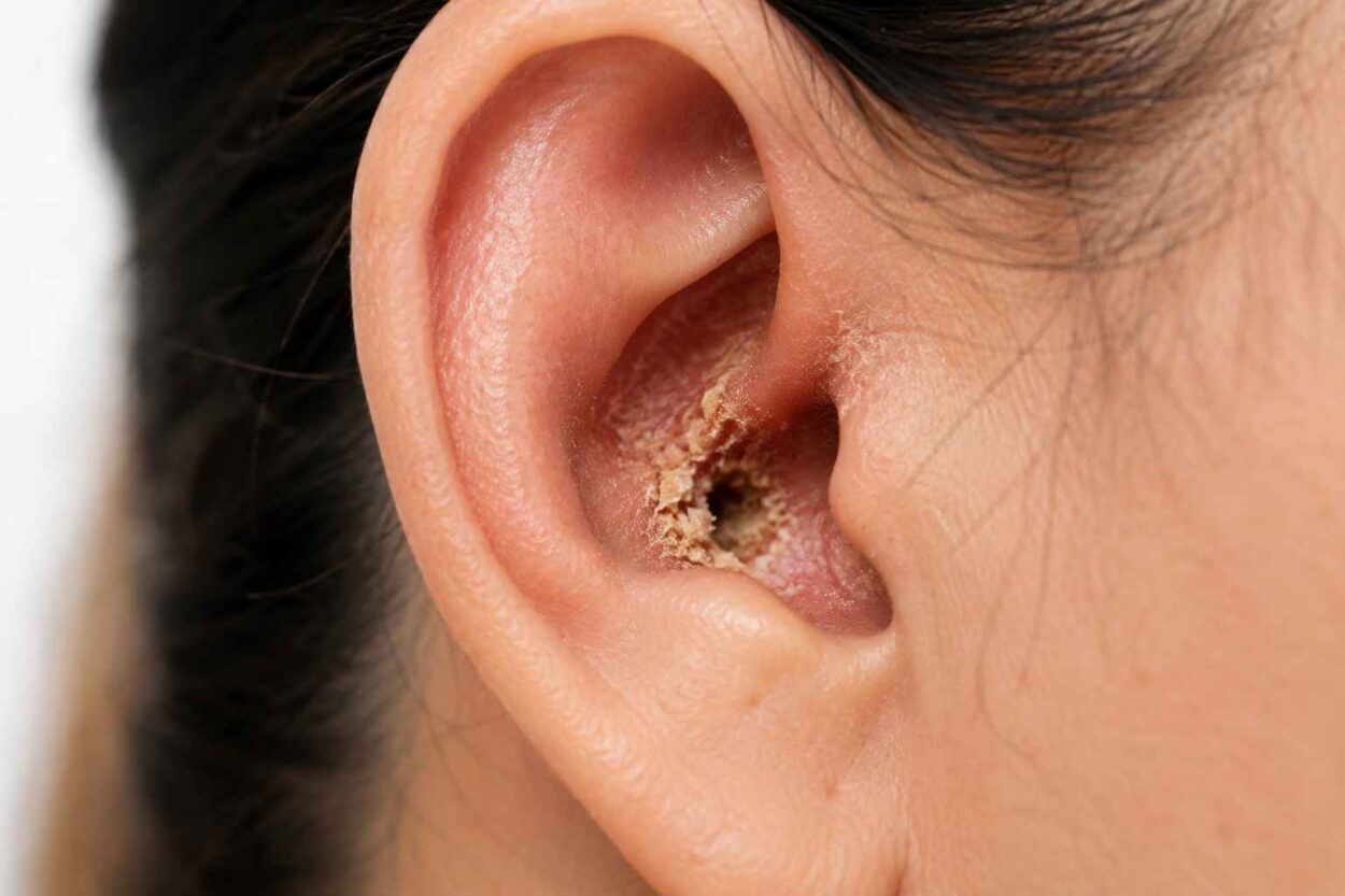 Close-up of a fungal infection affecting the ear canal.